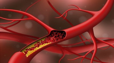 Νέα όρια για τη χοληστερόλη: Τι αλλάζει στις οδηγίες για την LDL