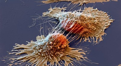 Καρκίνος του ήπατος: Το σημάδι που δεν πρέπει να αγνοήσετε